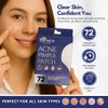 Pimple Patches-Hydrocolloid Acne Patches to fade acne & dark spots - High quality Clear invisible Patches for Skin Care-Covering Zits,Blemishes and Breakouts -Vegan,Cruelty Free- 3 Sizes,72 Count
