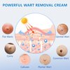 KIbabyDI Wart Remover Fast Acting Gel – Powerful Freeze Off Treatment for Genital Wart, Plantar Wart, Corns, and Flat Warts – 2 Pack-Red-1181