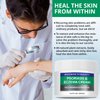 Hermon Psoriasis Eczema Relief Cream: Maximum Strength for Psoriasis Eczema - Relieve Symptom of Resistant Effective for Seborrheic Dermatitis Folliculitis 100m 3.4 Fl Oz (Pack of 1)