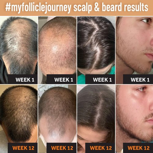 FOLLICLE BOOSTER Scalp and Beard Manual Massager - Silicone Hair Scrubber, Cleansing Care Brush - Ergonomic Exfoliator for Dandruff Removal That Promotes Healthy Hair Growth