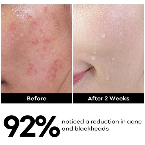 Salicylic Acid Face Cleanser, Daily Gentle Acne Cleansing Face Wash for Acne, Pore, Blackheads, Breakouts, Cleansing Gel for Oily & Sensitive Skin, 5.07 FL OZ