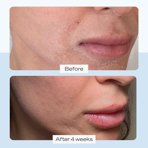 First Aid Beauty Ultra Repair Cream Intense Hydration Moisturizer for Face and Body - 8 oz.