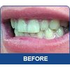 INSTANT WHITE SMILE optimized 30cc GELL ONLY syringes (NO TRAYS) 36% Professional Strength Carbamide Peroxide Teeth Whitening Gel only with Shade Card