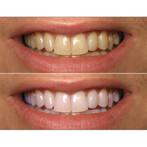 ProDental Teeth Whitening Gel Syringe Refill 10 Pack | 35% Carbamide Peroxide - 60 Treatments | Faster Results Than Tooth Whitening Strips - Pen - Powders and Toothpaste | Safe for Sensitive Teeth