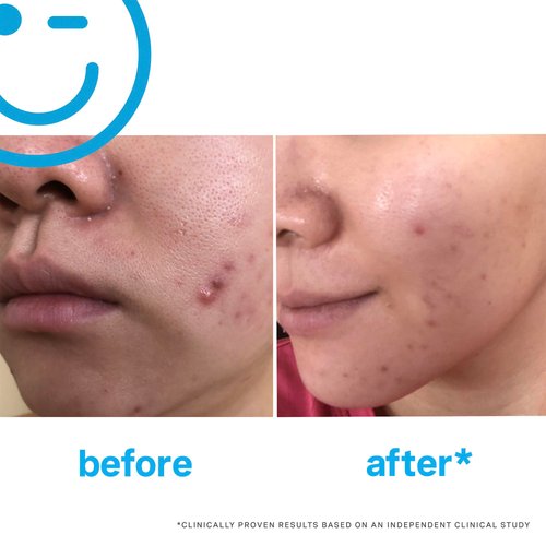 EradiKate 3% Sulfur Daily Foaming Cleanser Acne Treatment – Clinically Formulated Medicated Face Wash Balances Skin and Cleans Pores, 4 Fl Oz