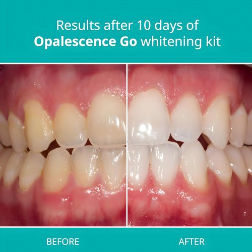 Opalescence Whitening Bundle - Opalescence Go 10% Hydrogen Peroxide Prefilled Whitening Trays and Whitening Toothpaste - Mint Flavor 5194-5166