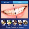 MagicBrite Complete Teeth Whitening Kit at Home Whitener - LED Light, 35% Carbamide Peroxide, 2 Mouth Trays, (3) 3ml Gel Syringes, Painless Effective
