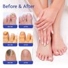 Toenail Fungus Treatment, Nail Fungus Treatment for Toenail, Toe Nail Fungus Treatment Extra Strength, Fungus Nail Treatment, Nail Fungus Treatment for Nail, Fungus Treatment for Fingernails