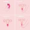 Intimina Lily Cup Size A - Ultra-Soft Menstrual Cup, Reusable Period Protection, Thin Menstrual Cup for up to 8 Hours, Medical-Grade Silicone Women’s Period Care