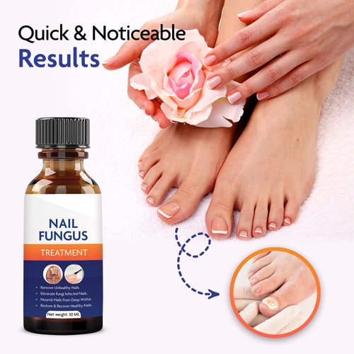 Toenail Fungus Treatment, Nail Fungus Treatment for Toenail, Toe Nail Fungus Treatment Extra Strength, Fungus Nail Treatment, Nail Fungus Treatment for Nail, Fungus Treatment for Fingernails