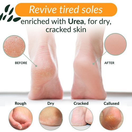 Tree to Tub Foot Cream for Dry Cracked Heels and Feet - Foot Lotion for Dry Cracked Feet, Non-Greasy Foot Moisturizer Urea Cream w/Softening Shea Cocoa Butter, Citrus Foot Care for Women & Men