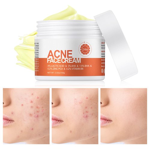 Acne Cream, Salicylic Acid Cystic Acne Treatment For Face, Back Butt Acne Treatment Cream, Acne Spot Treatment for Face and Body, Acne Clearing Cream Pimple Cream for Teens & Adults, Acne Moisturizer