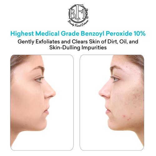 Acne Face wash Treatment with Benzoyl Peroxide 10% - Fight Acne Blemishes on Contact for Cystic Breakouts, Oily Skin, Clogged Pores, Blackhead, Whitehead & Pimples. Achieve Clear Skin.