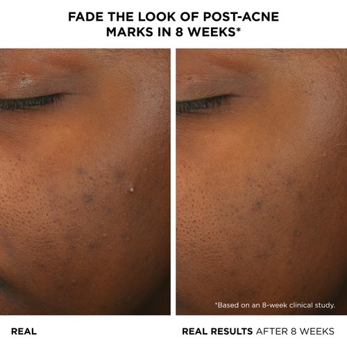 IT Cosmetics Bye Bye Breakout Acne Treatment Face Serum -With 2% Salicylic Acid & 3% Lactic Acid - Helps Reduce Pimples in 3 Days & Fades Look of Post-Acne Marks in 8 Weeks - 1 Fl. Oz