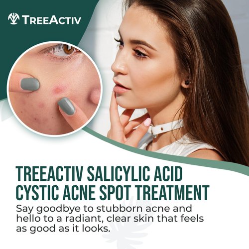 TreeActiv Salicylic Acid Cystic Acne Spot Treatment, 0.5 fl oz, Acne Treatment for Face, Acne Spot Cream, Hormonal Acne Treatment, Acne Spot Treatment for Face and Body, Acne Cream for Teens & Adults