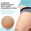 Ayadara Butt Acne Clearing Lotion, 8oz Butt Acne Cream with Salicylic Acid, Smoothing Butt Cream for Acne, Butt Acne Clearing Lotion for Women, Men, Teens, Chest and Back Acne Treatment, 90-Day Supply