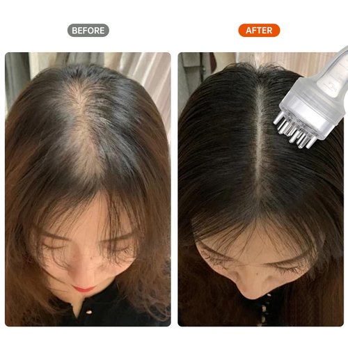 NERNJIM Minoxidil Applicator, Scalp Oil Applicator - Transparent easy to Observe, Easy to Clean, Controlled Flow Rate - Ideal for Minoxidiland & Wild Growth Hair Oil