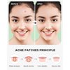 AGWO ACNE PIMPLE PATCHES, Spot Acne Treatment, Blackheads, Zit Clearing, Salicylic Acid, Facial Treatment for Blemishes, Razor Bumps, Ingrown Hairs, Vegan friendly Not Tested on Animals (36 Count)