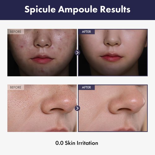 TOSOWOONG Real Spicule Ampoule with Spicule 30,000 Shot, Niacinamide, Amino Acid and Panthenol, Pore Minimizer, Exfoliating, Micro-sized, Needle-shaped Design, Korean Skincare, 30ml, 1.01 fl. oz.