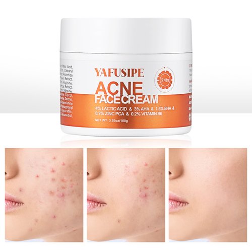 Acne Treatment for Face, Acne Cream Back Acne Treatment Cream for Teens & Adults Anti-acne Pimple Cream Butt Acne Clearing Cream, Acne Spot Treatment