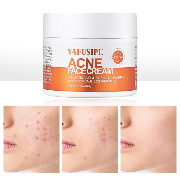 Acne Treatment for Face, Acne Cream Back Acne Treatment Cream for Teens & Adults Anti-acne Pimple Cream Butt Acne Clearing Cream, Acne Spot Treatment