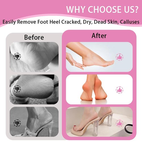 Electric Foot Callus Remover,MOWLIE Electric Foot Care Tools with Speed Controller and 60pcs Replacement Sandpaper Disk for Men Women Dead Dry Crack Skin Calluses (Pink)