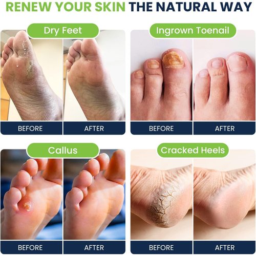 Tea Tree Oil & Soothing Lavender Foot Soak with Epsom Salt - Best Toenail Treatment & Softens Calluses - Soothes Sore & Tired Feet, Foot Odor Scent, Spa Pedicure - Made in USA - 16oz (Pack of 2)