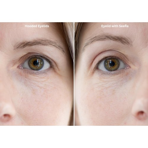 SeeRa: Instant Lifting Eyelid Tape for Hooded & Droopy Eyes - Hypoallergenic, Waterproof, Invisible Eye Lift Strips, Non-Surgical, Eyelid Lifters & Stickers (4mm-7mm) (5mm-Intermediate)