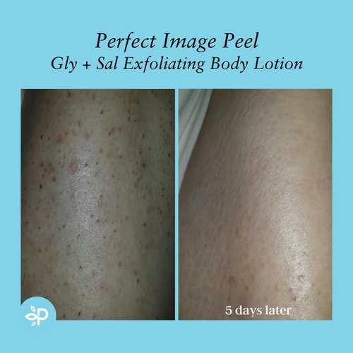 Perfect Image Gly + Sal Exfoliating Body Lotion, 8% Glycolic Acid and 2% Salicylic Acid Lotion Enhanced with Green Tea, Papaya, Bearberry, Licorice and Amino Complex