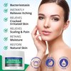 Hermon Psoriasis Eczema Relief Cream: Maximum Strength for Psoriasis Eczema - Relieve Symptom of Resistant Effective for Seborrheic Dermatitis Folliculitis 100m 3.4 Fl Oz (Pack of 1)