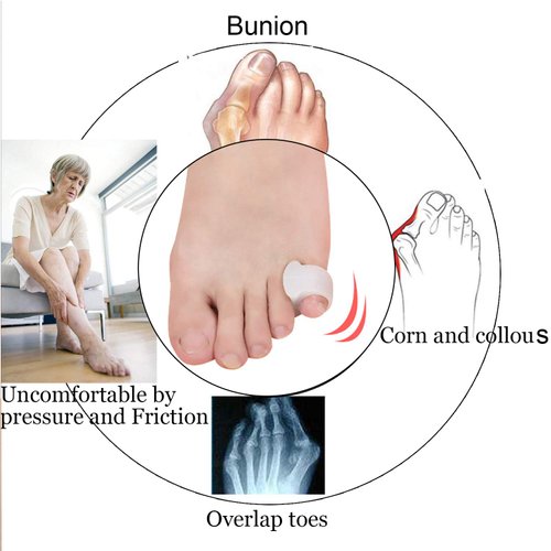 10 Pcs Pinky Toe Splint, Gel Toe Separators, Little Toe Straightener Hammer Toe for Men Women Walking, Running, Overlapping, Bunion Corrector and Bunion Relief