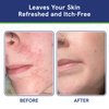 Itch Cream for Itchy Skin Relief - Moisturizing Cream & Face Lotion for Women - Redness Relief for Face & Body Cream - Hydrating Face Cream for Dry Skin & Itchy Scalp Relief - Anti Itch Lotion (4oz)