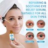 Eye Treatment Serum, Chalazion & Blepharitis Remover With Avocado Oil, Buckthorn Oil For Eyelid, 30ML Tea Tree Oil & Caffeine Eye Serum For Redness, Puffiness, Eye Relief.
