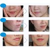 BIOAQUA 4in1 Face Acne Treatment Scar Removal Spots Pimples Oil Cream Face Masks Scar Blemish Marks Moisturizing Oil 100g+30g+30ml+4pcs X30g