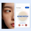 Custom Hydrocolloid Pimple Patch – Targeted Acne Cover for Skincare and Beauty. Acne Patch (pack of 1)
