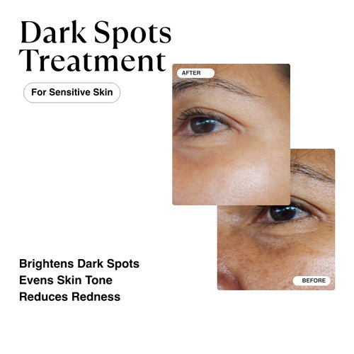 MATKAS Korean Dark Spot Remover for Face Serum - for Uneven Skin Tone, Hyperpigmentation Treatment, Dark Spot Corrector, Discoloration Correcting - Niacinamide, Oat Extract, Green Tea, Hyaluronic Acid