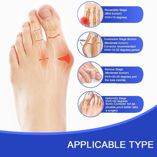 Toe Corrector Toe Separator Bunion Splint 【2024 Updated】 Hallux Valgus Bunion Big Toes Corrector Set Bunion Brace Bunion Exercise Strap Orthopedic Kit Bunion Pain Relief (free, Blue)
