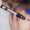 Skin Clinic Freeze Point for Warts and Skin Tags
