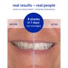 Supersmile Dissolving Superstrips - Professional Teeth Whitening Strips - Enamel Safe Teeth Whitener For Sensitive Teeth