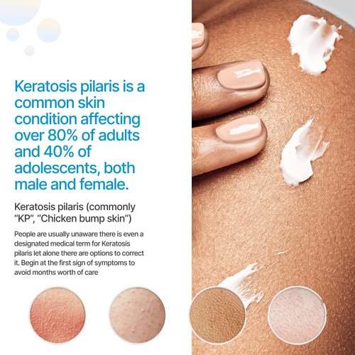 KP Essentials - Keratosis Pilaris Exfoliating Body Wash - Wash Away Red Bumps Caused By KP for Confident Clear Skin, 6oz (1 Bottle)