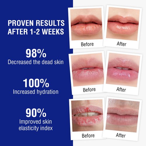 Medicated Lip Balm w/Beeswax, Petrolatum, Peppermint Oi, 100% Natural Ingredients, 24H Long-lasting Hydrating Healing Lip Balms, Lip Moisturizer for Very Dry Lips, Echapped Lips Treatment Severe