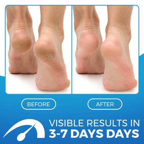 2 in 1 Foot Cream for Dry Cracked Heels - XL Foot Repair Cream for Dry Feet - Suitable for Diabetics - Used by Professionals