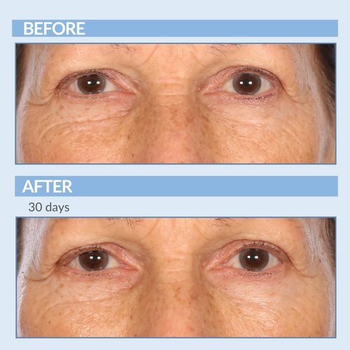 Serious Skincare - A Eye XR Retinol Under Eye Cream Concentrate for Dark Circles & Puffiness, Daily Wrinkle Cream - Anti-Aging - Line Smoothing Skin Care Treatment - Stocking Stuffers - 0.5 oz