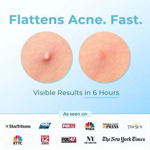 Pimple Patches (Made in Korea) for Face & Body - Overnight Treatment - Acne Patch for Zits, Bumps, Spots, Pimples, Whiteheads - Hydrocolloid Stickers - Vegan, Cruelty-Free, Hypoallergenic (8,10,12,14)