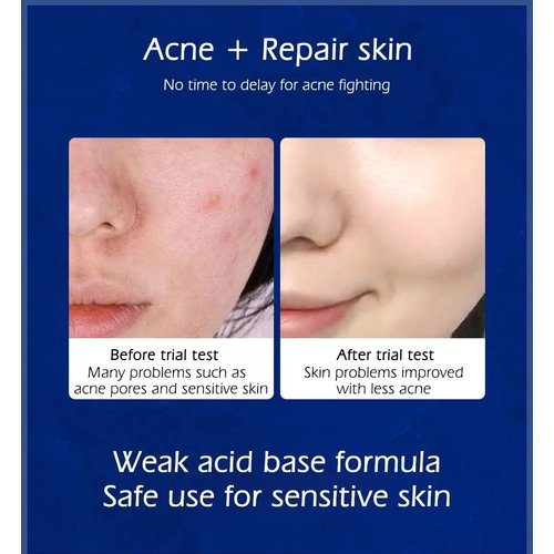 Cystic, Hormonal, Severe Acne Treatment Cream for Teens & Adults with Hyaluronic Acid Aloe Vera Oil Overnight Cystic , Unisex Sensitive Skin Blind Pimple & Blemish Remover (1 PACK)