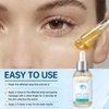 LA.PERSONAL Stye Eye Treatment, Chalazion Remover, Eye Serum for Styes Chalazion and Blepharitis Treatment, with Avocado oil, Sea buckthorn oil & Caffeine 1.01 Fl oz/30 Ml