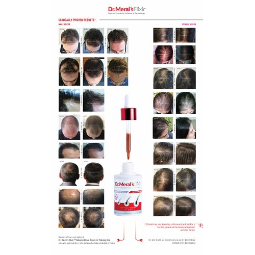 Dr. Meral's Elixir - Essential Hair Growth Products Kit: Minoxidil Free Thinning Hair Serum with Saw Palmetto & Sodium Lauryl Sulfate Free Shampoo for Hair Loss - DHT Blocker, Stimulates Hair Regrowth