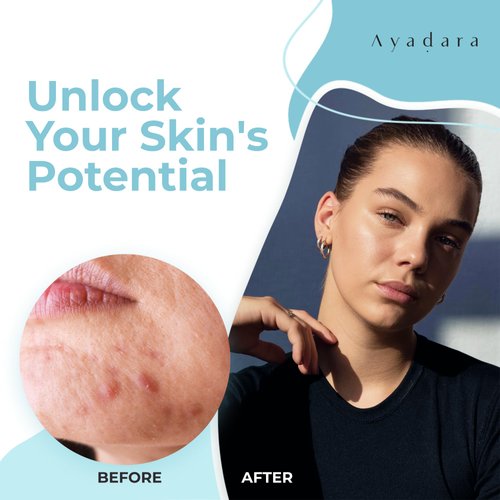 AYADARA Acne Charcoal Face Wash, 8 oz, Adult Acne Face Wash for Women & Men with Activated Charcoal, Charcoal Cleanser Face Wash Face Cleanser for All Skin Types, Facial Cleanser for Men, 425+ Uses