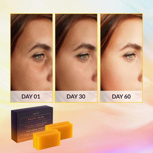 VALITIC Kojic Acid Vitamin C and Retinol Soap Bars with Turmeric for Dark Spot - Original Japanese Complex Infused with Collagen, Hyaluronic Acid, and Vitamin E (4 Pack)