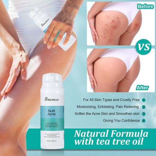 Butt Acne Clearing Treatment (3.4 OZ), Butt Acne Treatment for Clearing Acne, Pimples, Blackheads, Zits and Razor Bumps for the Buttocks, Thigh and Back Acne